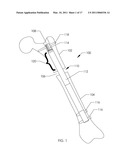 BONE GROWTH DEVICE AND METHOD diagram and image