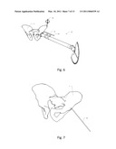 Hip surgery assembly diagram and image