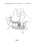 BONE REGENERATION DEVICE diagram and image