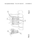 BONE REGENERATION DEVICE diagram and image