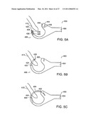 PLACING SUTURES diagram and image