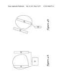 Anterior Active Housing Subcutaneous Positioning Methods diagram and image