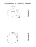 Anterior Active Housing Subcutaneous Positioning Methods diagram and image