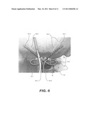 STIMULATION OF A STIMULATION SITE WITHIN THE NECK OR HEAD diagram and image