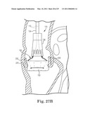 SURGICAL DELIVERY DEVICE AND METHOD OF USE diagram and image