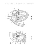 METHODS, SYSTEMS AND DEVICES FOR CARDIAC VALVE REPAIR diagram and image