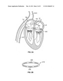 METHODS, SYSTEMS AND DEVICES FOR CARDIAC VALVE REPAIR diagram and image