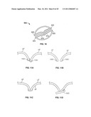 METHODS, SYSTEMS AND DEVICES FOR CARDIAC VALVE REPAIR diagram and image