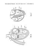 METHODS, SYSTEMS AND DEVICES FOR CARDIAC VALVE REPAIR diagram and image