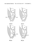 METHODS, SYSTEMS AND DEVICES FOR CARDIAC VALVE REPAIR diagram and image