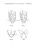 METHODS, SYSTEMS AND DEVICES FOR CARDIAC VALVE REPAIR diagram and image