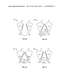 METHODS, SYSTEMS AND DEVICES FOR CARDIAC VALVE REPAIR diagram and image