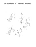 METHODS, SYSTEMS AND DEVICES FOR CARDIAC VALVE REPAIR diagram and image