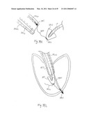 METHODS, SYSTEMS AND DEVICES FOR CARDIAC VALVE REPAIR diagram and image