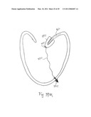 METHODS, SYSTEMS AND DEVICES FOR CARDIAC VALVE REPAIR diagram and image