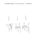 METHODS, SYSTEMS AND DEVICES FOR CARDIAC VALVE REPAIR diagram and image