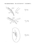 METHODS, SYSTEMS AND DEVICES FOR CARDIAC VALVE REPAIR diagram and image