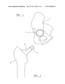 INSTRUMENT FOR USE IN A JOINT REPLACEMENT PROCEDURE diagram and image