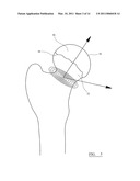INSTRUMENT FOR USE IN A JOINT REPLACEMENT PROCEDURE diagram and image