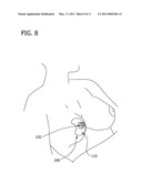 NIPPLE SHIELD diagram and image