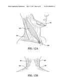 CERVICAL COLLAR WITH REDUCED VASCULAR OBSTRUCTION diagram and image