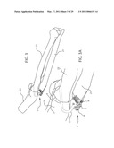 INTERNAL JOINT STABILIZER DEVICE, SYSTEM AND METHOD OF USE diagram and image