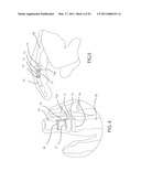 INTERNAL JOINT STABILIZER DEVICE, SYSTEM AND METHOD OF USE diagram and image