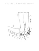 INTERNAL JOINT STABILIZER DEVICE, SYSTEM AND METHOD OF USE diagram and image