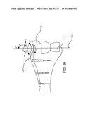 INTERNAL JOINT STABILIZER DEVICE, SYSTEM AND METHOD OF USE diagram and image