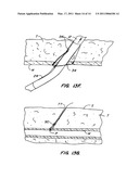 ARTICULATING SUTURING DEVICE AND METHOD diagram and image