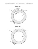 Expandable Ring Intervertebral Fusion Device diagram and image