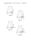 Surgical Tools for Arthroplasty diagram and image