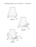 Surgical Tools for Arthroplasty diagram and image