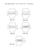 Surgical Tools for Arthroplasty diagram and image