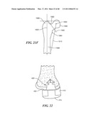 Surgical Tools for Arthroplasty diagram and image