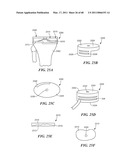 Surgical Tools for Arthroplasty diagram and image