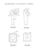 Surgical Tools for Arthroplasty diagram and image