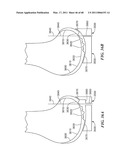 Surgical Tools for Arthroplasty diagram and image