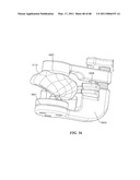 Surgical Tools for Arthroplasty diagram and image