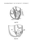 METHODS, SYSTEMS AND DEVICES FOR CARDIAC VALVE REPAIR diagram and image