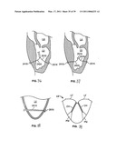METHODS, SYSTEMS AND DEVICES FOR CARDIAC VALVE REPAIR diagram and image