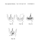 SURGICAL GUIDES AND METHODS FOR POSITIONING ARTIFICIAL TEETH AND DENTAL IMPLANTS diagram and image