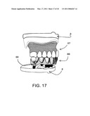 SURGICAL GUIDES AND METHODS FOR POSITIONING ARTIFICIAL TEETH AND DENTAL IMPLANTS diagram and image