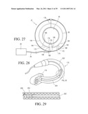 IMPLANTABLE RESTRICTION SYSTEM WITH RELEASE MECHANISM diagram and image