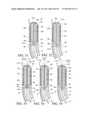 IMPLANTABLE RESTRICTION SYSTEM WITH RELEASE MECHANISM diagram and image