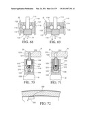 IMPLANTABLE RESTRICTION SYSTEM WITH RELEASE MECHANISM diagram and image