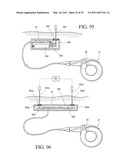 IMPLANTABLE RESTRICTION SYSTEM WITH RELEASE MECHANISM diagram and image