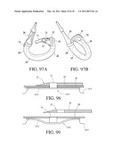 IMPLANTABLE RESTRICTION SYSTEM WITH RELEASE MECHANISM diagram and image