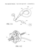 IMPLANTABLE RESTRICTION SYSTEM WITH RELEASE MECHANISM diagram and image