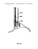 Tissue Retractor and Method for Using the Retractor diagram and image